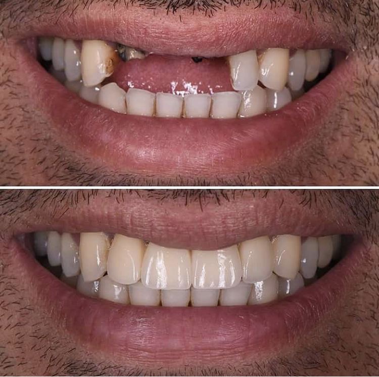 Before and After Transformation 2