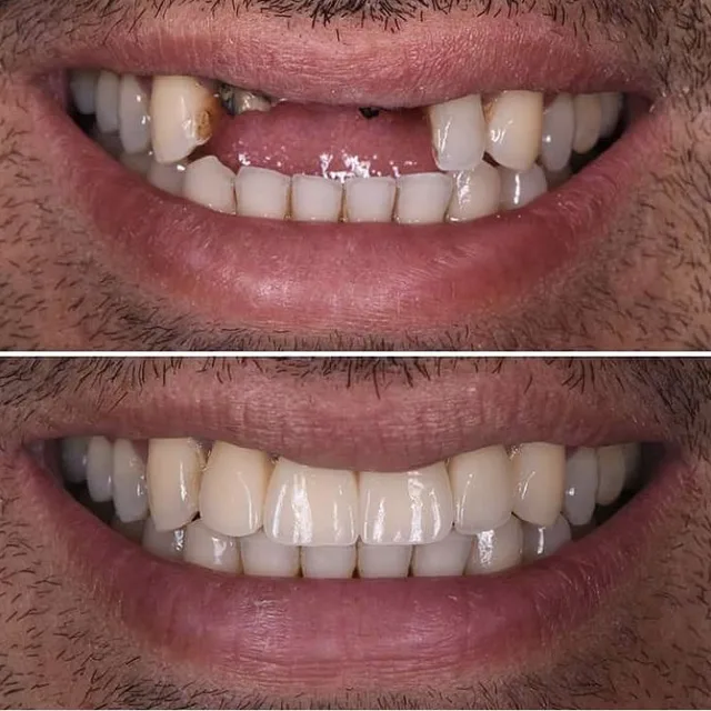 Before and after dental transformation 2